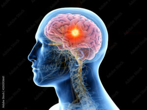 3d rendered medically accurate illustration of the human brain and a tumor
